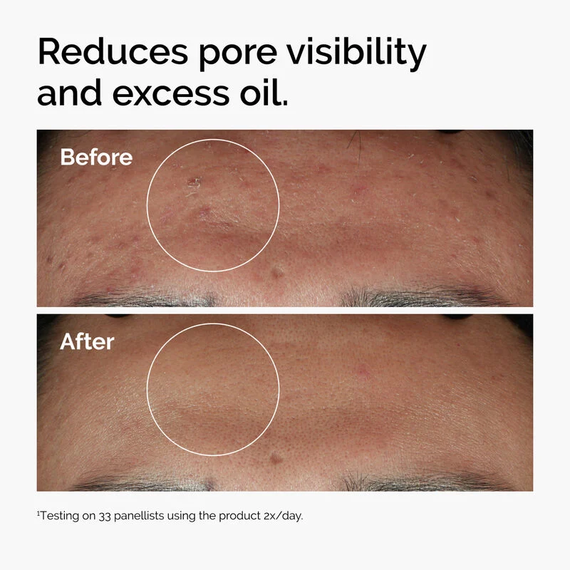 The Ordinary Niacinamide 10% + Zinc 1% 30Ml - Image 5